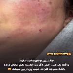 تزریق پی آر پی صورت